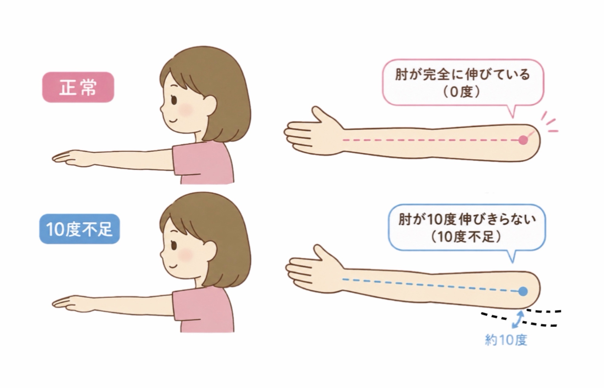 肘伸展